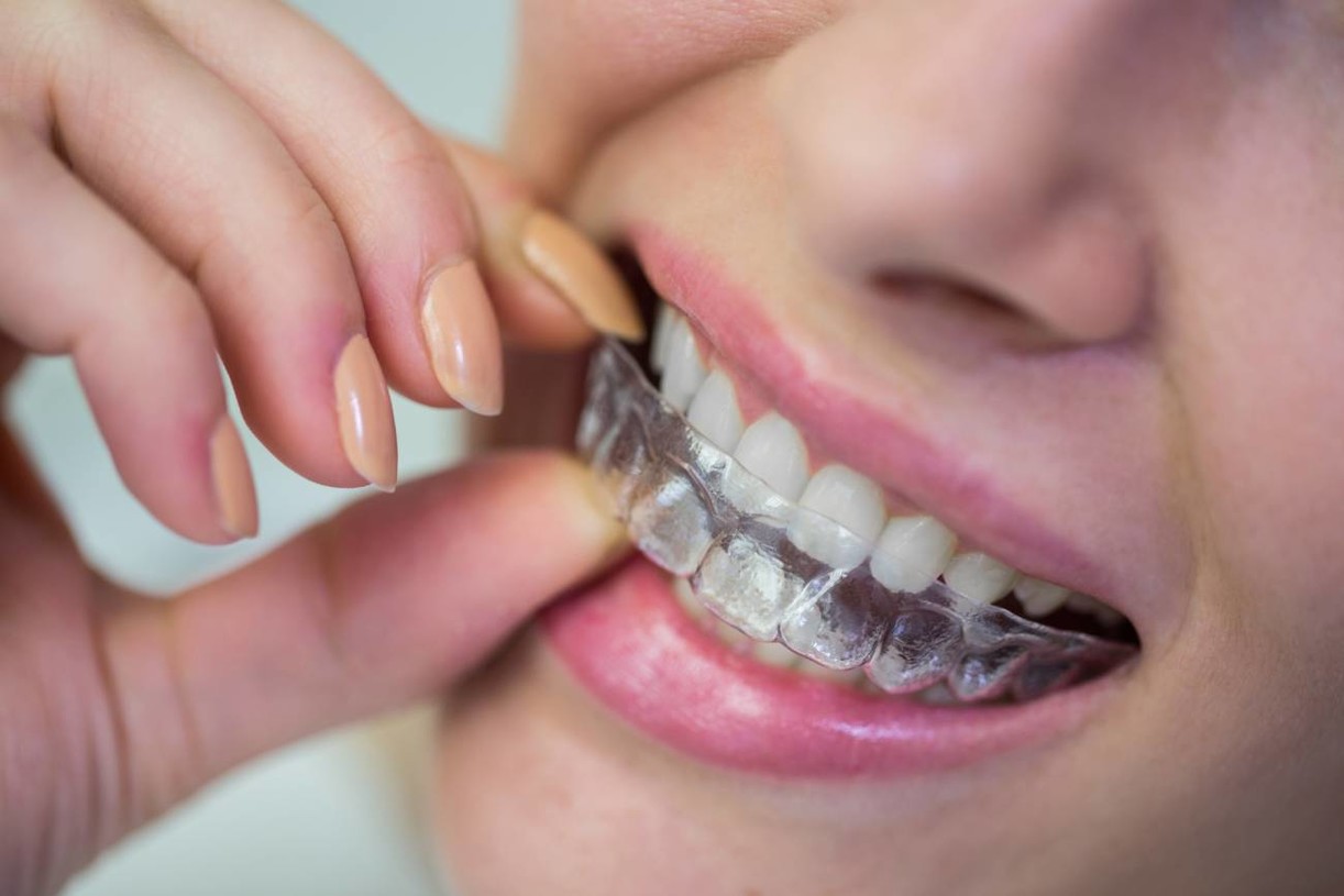 mujer usando Invisalign en Barcelona