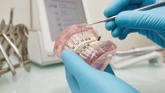 Por qué elegir brackets metálicos en Clínica Smile