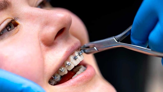Qué es la ortodoncia y cómo puede ayudarte
